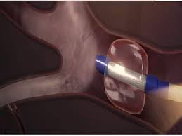 Thermal Vapor Ablation for Emphysema 11.00am